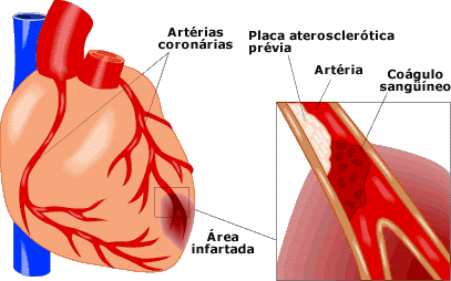 Bildergebnis für enfarte do miocardio