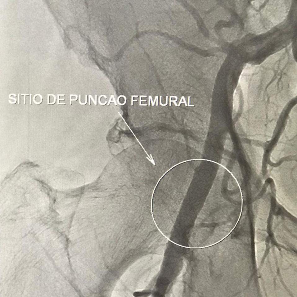 Implante percutneo de valva aortica (TAVI)