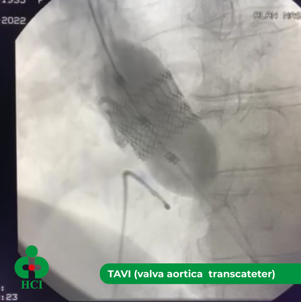 TAVI (valva aortica  transcateter) 