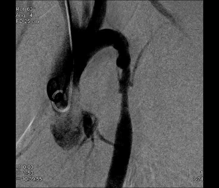 Aortoplastia com stent em coartao de aorta nativa