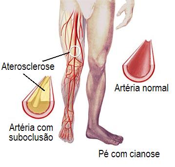 ANGIOPLASTIA EM DOENA ARTERIAL OBSTRUTIVA PERIFRICA 