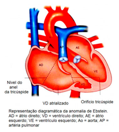 Anomalia de Ebstein