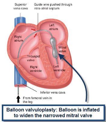 VALVOTOMIA MITRAL PERCUTNEA POR CATTER BALO