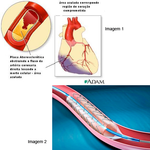 Fique atento aos sinais do infarto - Circular Cirurgia Vascular