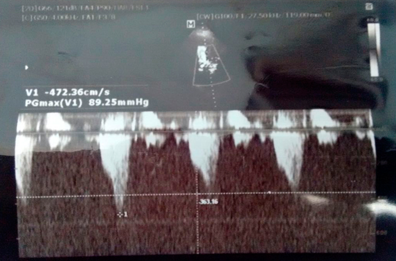 Ablao septal alcolica percutnea