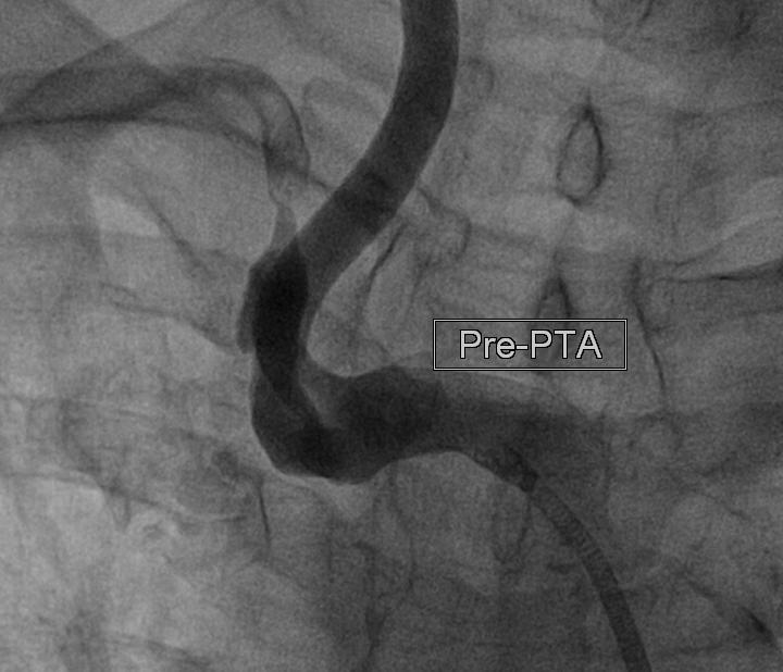 ANGIOPLASTIA COM IMPLANTE DE STENT PARA ARTRIA SUBCLVIA DIREITA