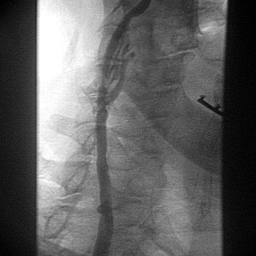 ANGIOPLASTIA DE CARTIDAS E VERTEBRAL