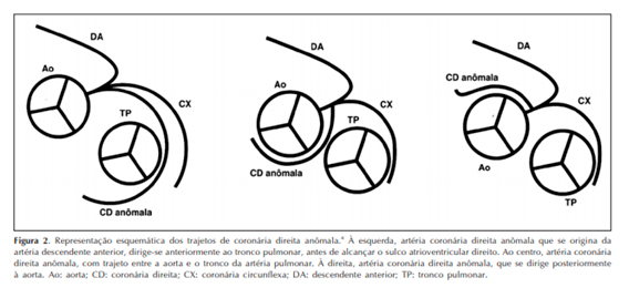 Anomalia de Coronria Direita 