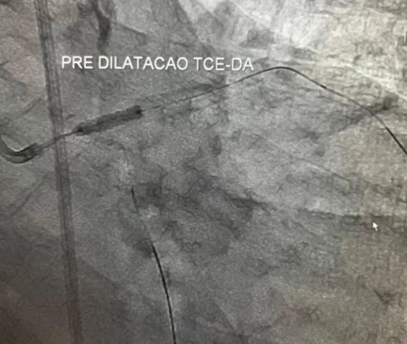 Angioplastia Coronariana