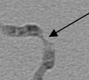 ANGIOPLASTIA CAROTÍDEA