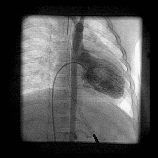 COMUNICAO INTERATRIAL COM HIPERTENSO PULMONAR