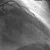 ESPASMO REVERTIDO DE ORIGEM DE DESCENDENTE ANTERIOR E ANGIOPLASTIA CONVENCIONAL DE CORONÁRIA DIREITA EM INFARTO AGUDO DO MIOCÁRDIO