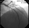 ANGIOPLASTIA ELETIVA NO INFARTO DO MIOCÁRDIO