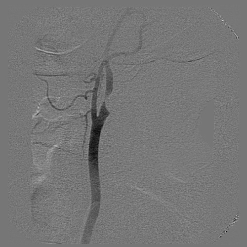 ANGIOPLASTIA DE CARTIDA INTERNA COM STENT E FILTRO DE PROTEO CEREBRAL