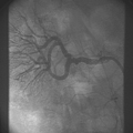 FIBRODISPLASIA DE ARTRIA RENAL