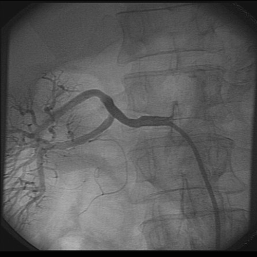 ANGIOPLASTIA DE ARTRIA RENAL