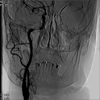 ANGIOPLASTIA NO SEGMENTO PETROSO DA ARTRIA CARTIDA INTERNA