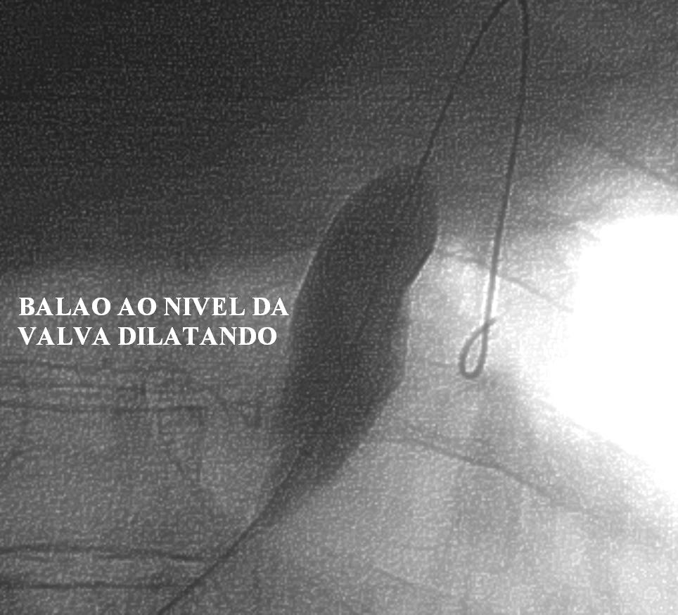 VALVOPLASTIA
