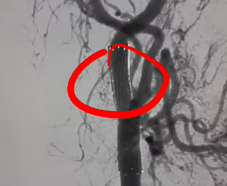 Angioplastia